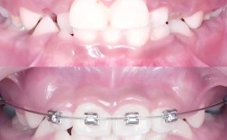 口腔正畸中SNB角度的具体含义是什么？