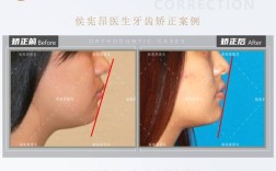 咬合侧偏一点点，正畸治疗有必要吗？