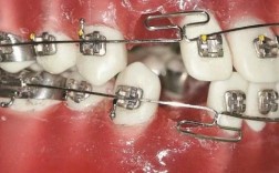 正畸meaw弓弯制的技巧与难点有哪些？