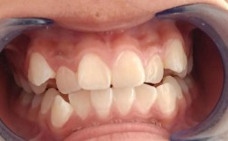 牙齿矫正牙齿不贴合，是什么原因导致的？该如何解决？