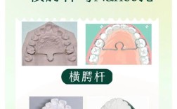 正畸nance托怎么玩