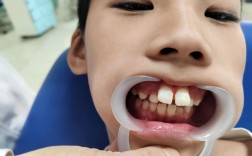 针对伸长牙的正畸治疗方法有哪些？如何选择合适的治疗方案？