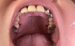 正畸后烤瓷牙牙龈红肿，是材料刺激还是正畸影响？