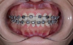 正畸固定患者掉片