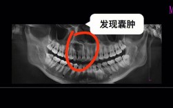 根尖囊肿术后有哪些治疗方法？如何根据病情选择最佳方案？