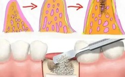 整牙为何要植骨？植骨是整牙的必要准备吗？