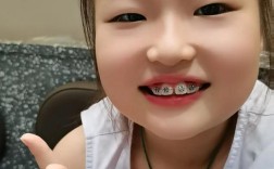 正畸托槽边缘变黑是正常现象吗？背后可能隐藏哪些口腔问题？如何有效处理并避免复发？