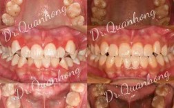 广州成年人牙齿正畸