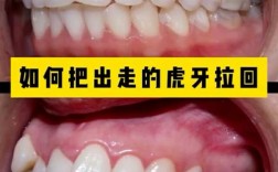 正畸虎牙到底要不要拔掉？