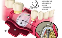 种牙什么情况下要植骨