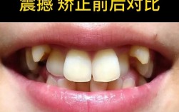 21岁想矫正牙齿