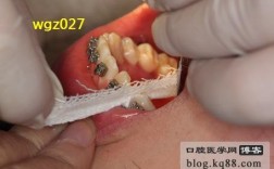 正畸邻面去釉步骤