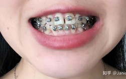 南京矫正牙齿，医院怎么选？费用要多少？效果如何？