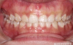 牙齿矫正后为何有牙缝？原因分析与应对方法