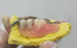 可摘义齿上颌架方法