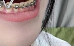 牙齿缝隙可以通过矫正闭合吗？