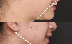 牙齿矫正真的会导致下巴变短吗？原因是什么？