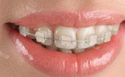 关于半透明陶瓷正畸