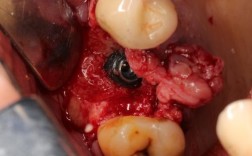 植牙植骨后血块