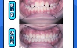 龅牙矫正更快的方法有哪些？如何高效实现？