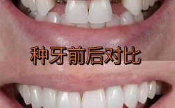 种植牙和真牙哪个更好？从使用体验、耐用性到维护成本全面对比