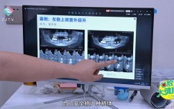 上颚植牙手术视频全过程