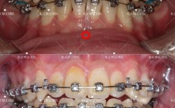 正畸压低前牙会怎么样