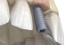 种牙植骨如何实现白色牙齿自然美观？