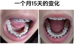 38岁矫正牙齿还来得及吗？成年人正畸还有机会吗？