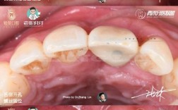 牙槽骨骨吸收会影响种牙吗？骨吸收后还能成功种牙吗？需要做哪些骨修复准备才能种牙？