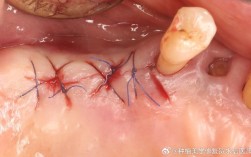 植完牙拆线痛吗