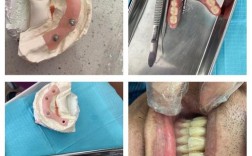 拜博口腔种植牙脱落为何发生？真相待解