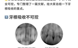 正畸中牙根吸收是怎么回事？有何影响与应对方法？
