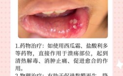口疮快速治好，有哪些好方法？