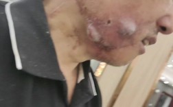 种植牙后引起口腔癌