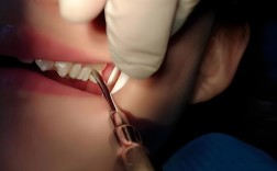 47号牙拔牙种牙