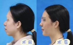 骨性错颌二类正畸