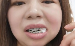 15岁牙齿矫正为何要拔牙？有何影响？