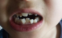 正畸期间门牙歪了，是矫正异常还是正常现象？