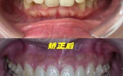 irok隐形正畸效果好吗？适合哪些人矫正？