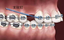 正畸支抗钉收钱吗