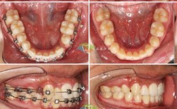 正畸关闭间隙两边不一致，原因何在？如何调整？