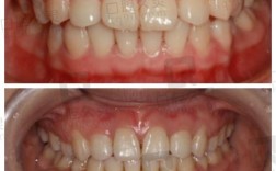 华美正畸效果怎么样