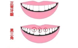 正畸什么是黑三角