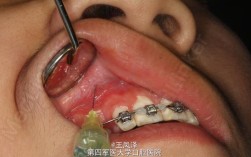 外科正畸导萌术