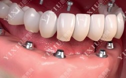 珠海摩尔口腔种牙效果如何？价格透明吗？值得信赖吗？