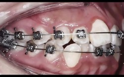 北京牙齿矫正效果怎么样？医院怎么选？价格贵不贵？