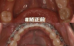 临牙倾斜种牙为何要先矫正？