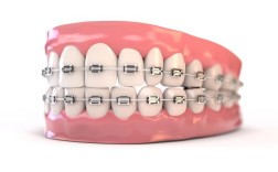 散在间隙正畸kq88，如何有效关闭牙齿间隙？