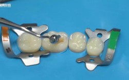 后牙形态树脂堆塑方法